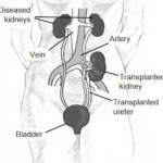 kidney transplant kdigo
