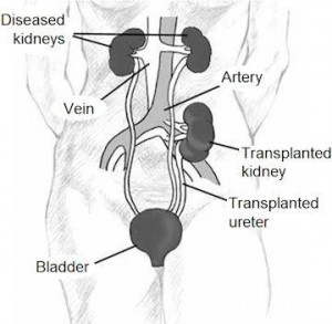 kidney transplant